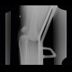 Dislocation of knee: X-ray - Plain radiograph